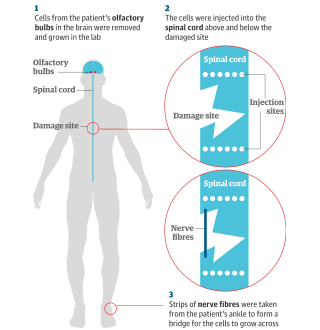 Illustration for article titled Paralyzed Man Walks Again After Brain Cells Are Injected into His Spine